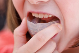 correction of child malocclusion by pre-orthodontic trainer - Cabinet d'orthodontie de Fabrice LIEGEOIS, Annick BRUWIER, Marie LEROUX, Virginie LEVAUX et Anaïs CLERMONT, à Liège